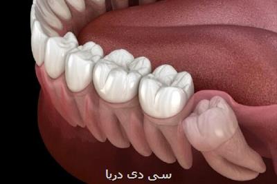 ساخت دستگاهی کاربردی در ترمیم ریشه دندان توسط فناوران ایرانی