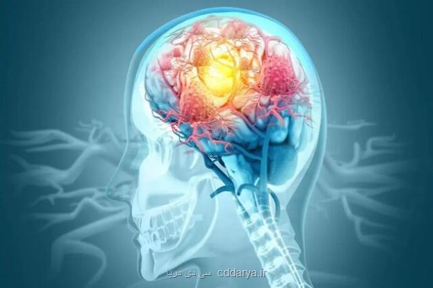 درمان موفق صرع با تزریق نورون به مغز
